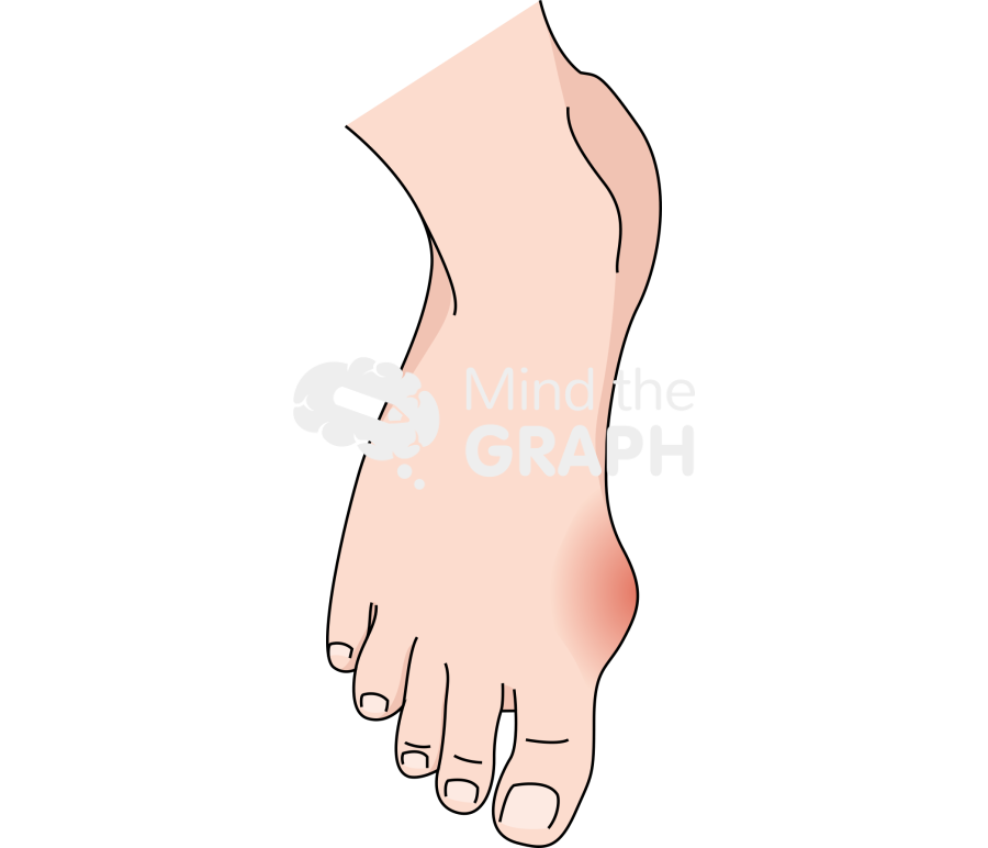 Foot gouty tophus Icons, Symbols, Pictures, and Images