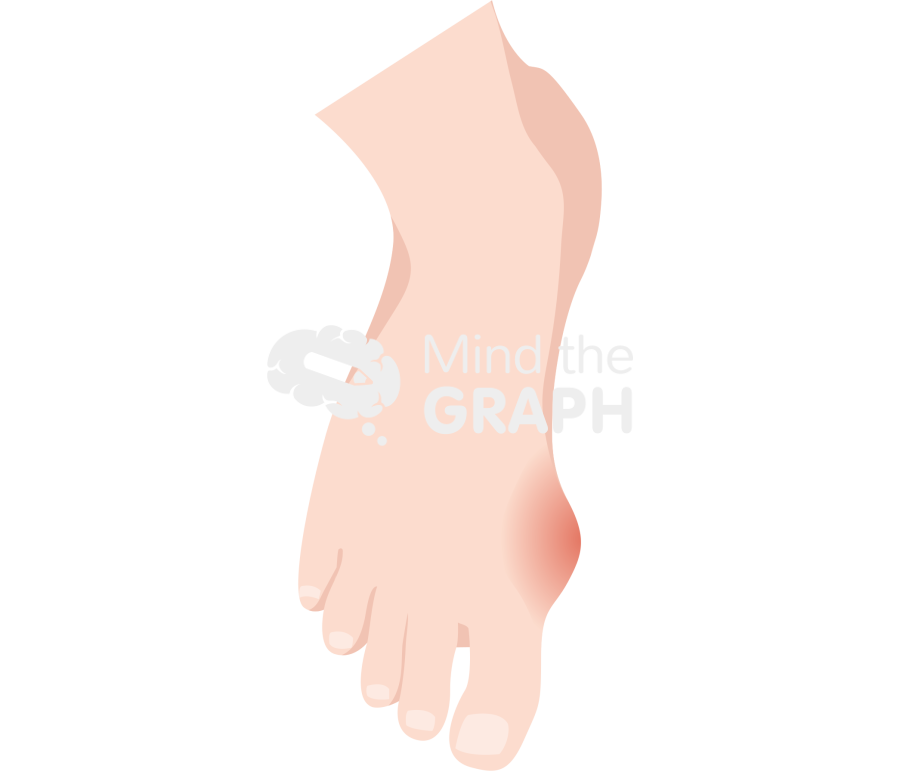 Foot gouty tophus Icons, Symbols, Pictures, and Images