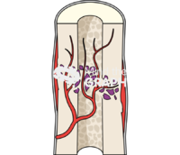 Fracture repair 3 Icons, Symbols, Pictures, and Images