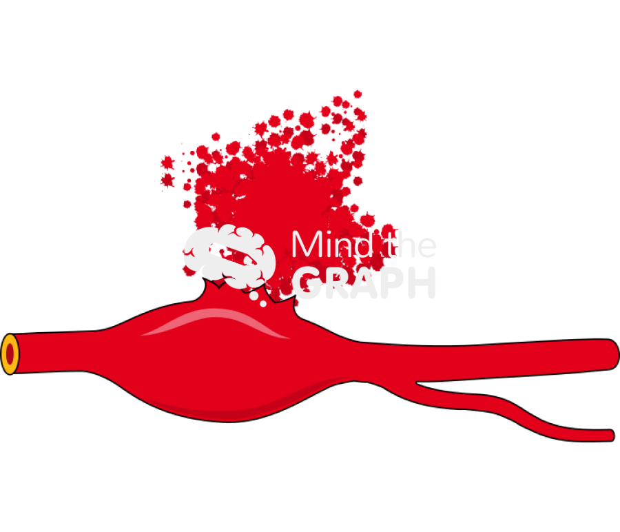 Fusiform aneurysm open Icons, Symbols, Pictures, and Images