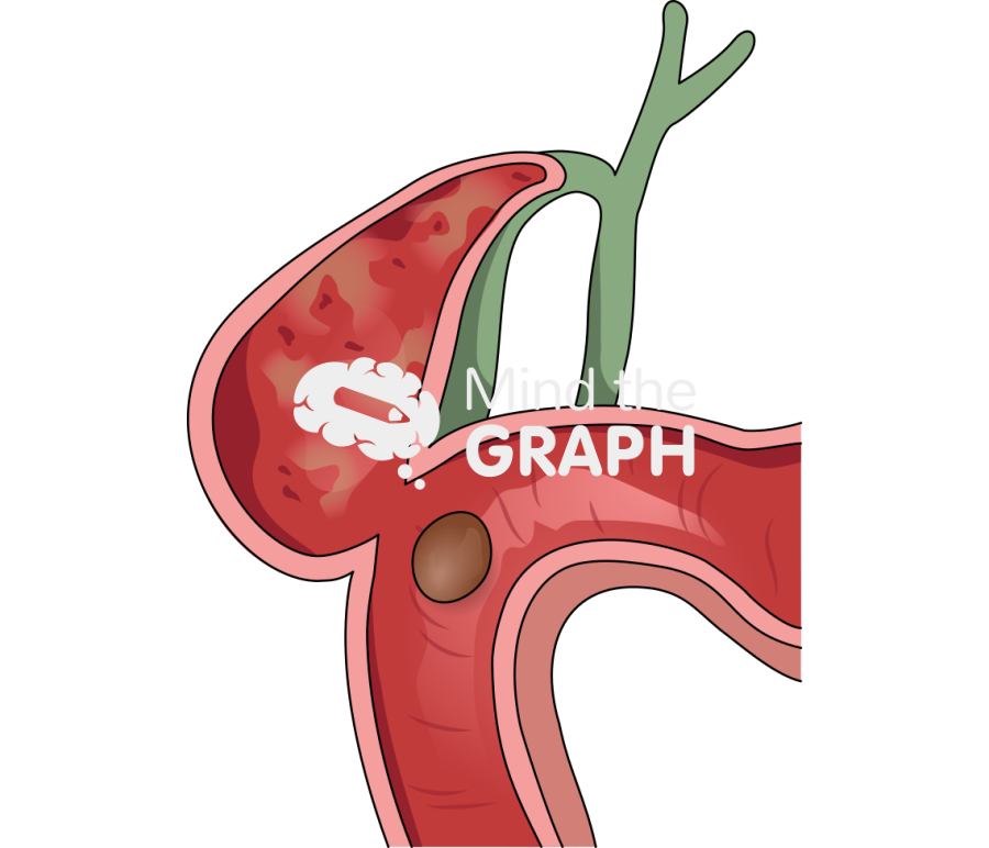 Gallbladder duodenal cholecystoduodenal fistula cut Icons, Symbols, Pictures, and Images