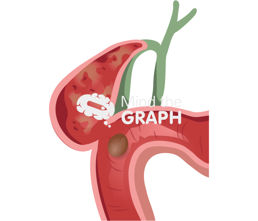 Gallbladder duodenal cholecystoduodenal fistula cut Icons, Symbols, Pictures, and Images