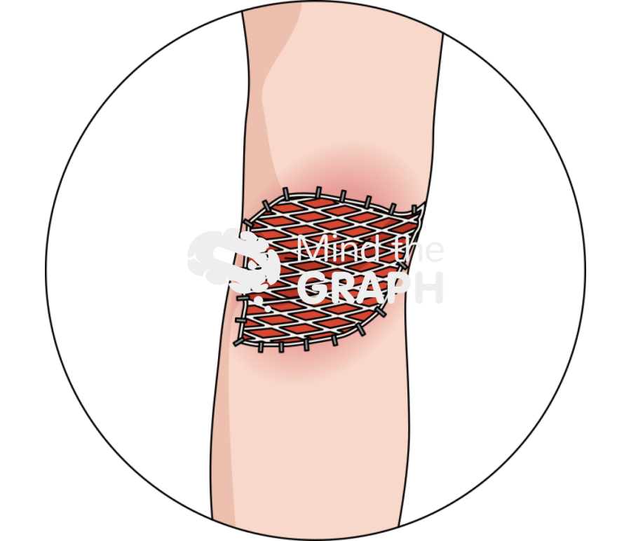 Gastrocnemius muscle flap skin graft zoom Icons, Symbols, Pictures, and Images