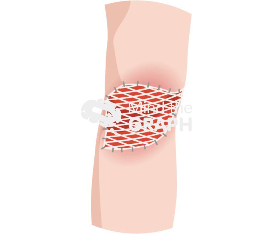 Gastrocnemius muscle flap skin graft zoom Icons, Symbols, Pictures, and Images