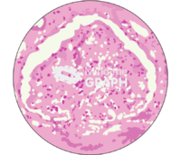 Glomerulonefritis proliferativa zoom - Edit and Customize Icons of Glomerulonefritis proliferativa zoom Glomerulonefritis proliferativa zoom Icons, Symbols, Pictures, and Images