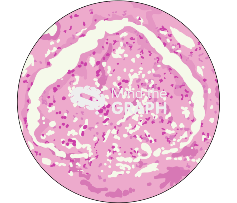 Glomerulonefritis proliferativa zoom Icons, Symbols, Pictures, and Images