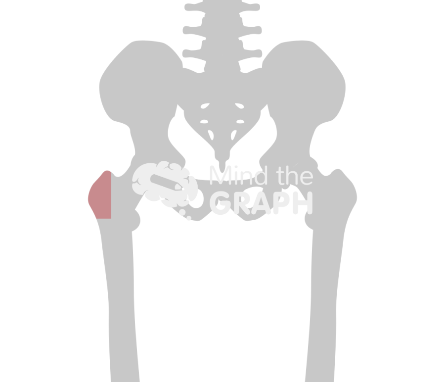 Greater trochanter osteotomy 1 bone Icons, Symbols, Pictures, and Images