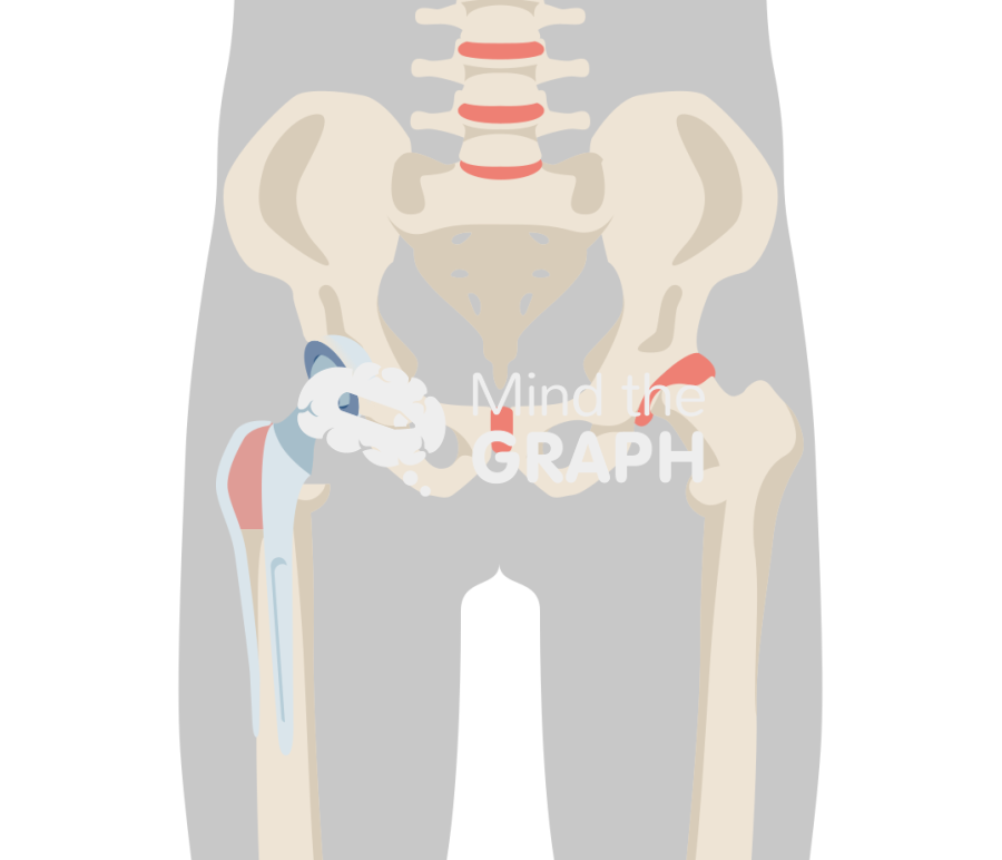Greater trochanter osteotomy 2 body Icons, Symbols, Pictures, and Images
