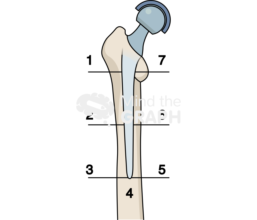 Gruen zones anteroposterior bone full Icons, Symbols, Pictures, and Images