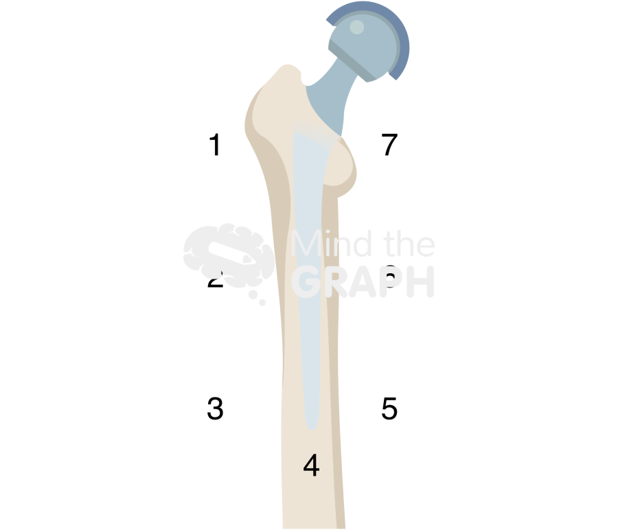 Gruen zones anteroposterior bone full Icons, Symbols, Pictures, and Images