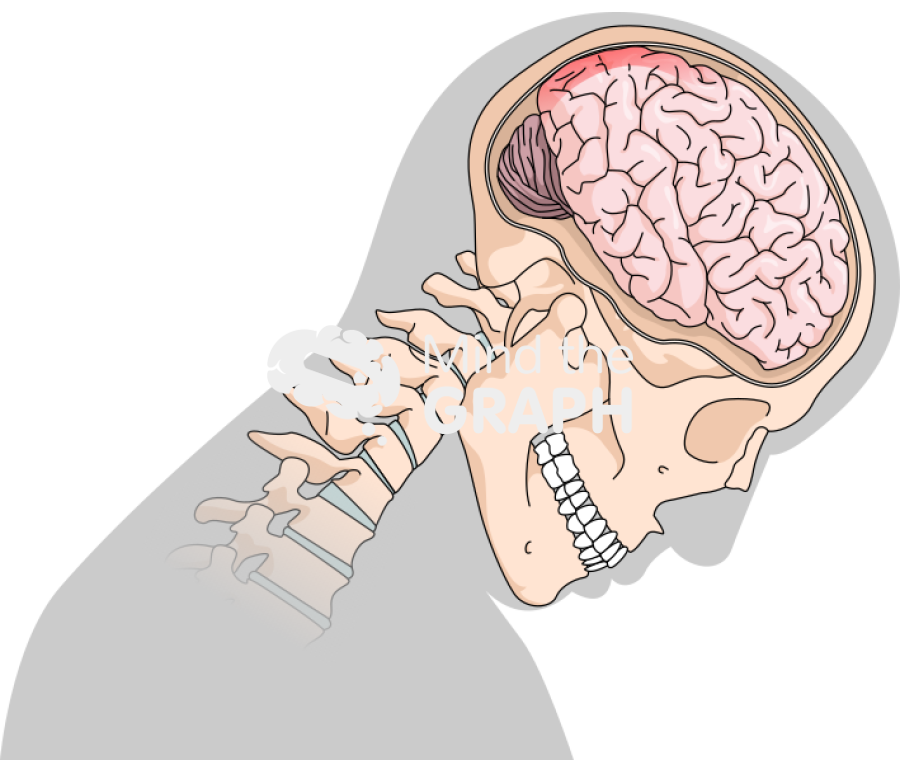 Head movement diffuse axonal injury 3 Icons, Symbols, Pictures, and Images
