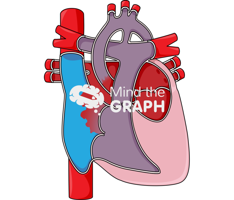 Heart hypoplastic left heart syndrom Icons, Symbols, Pictures, and Images