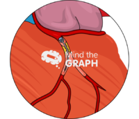 Heart left main percutaneous coronary intervention zoom Icons, Symbols, Pictures, and Images