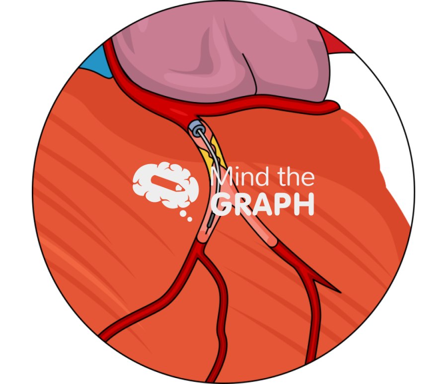 Heart left main percutaneous coronary intervention zoom Icons, Symbols, Pictures, and Images