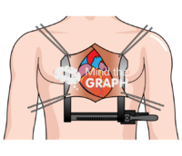 Heart surgery finochietto 2 - Edit and Customize Icons of Heart surgery finochietto 2 Heart surgery finochietto 2 Icons, Symbols, Pictures, and Images