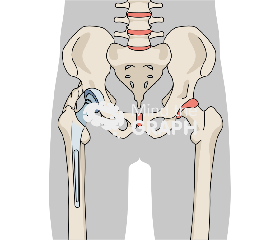 Heterotopic ossification total hip arthroplasty body Icons, Symbols, Pictures, and Images