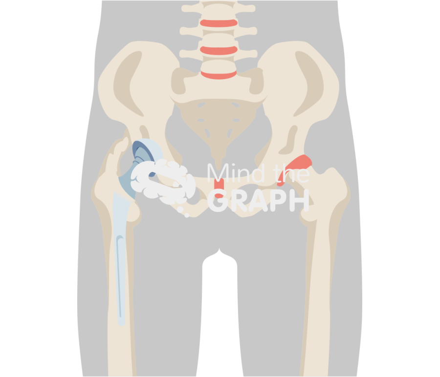 Heterotopic ossification total hip arthroplasty body Icons, Symbols, Pictures, and Images
