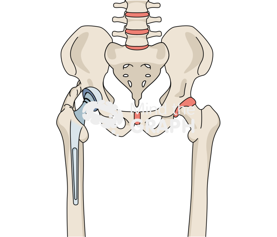 Heterotopic ossification total hip arthroplasty bone full Icons, Symbols, Pictures, and Images
