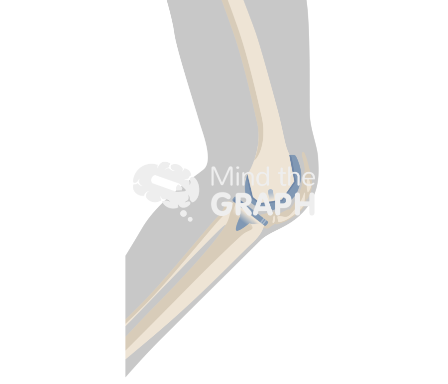 Heterotopic ossification total knee arthroplasty body Icons, Symbols, Pictures, and Images