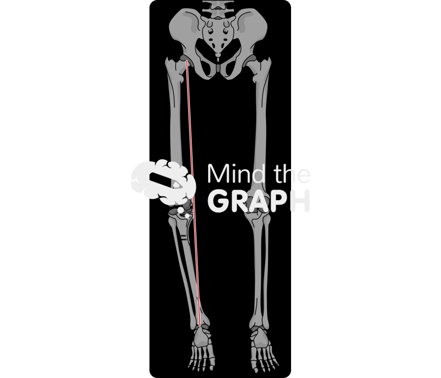 High tibial osteotomy alignment x ray Icons, Symbols, Pictures, and Images