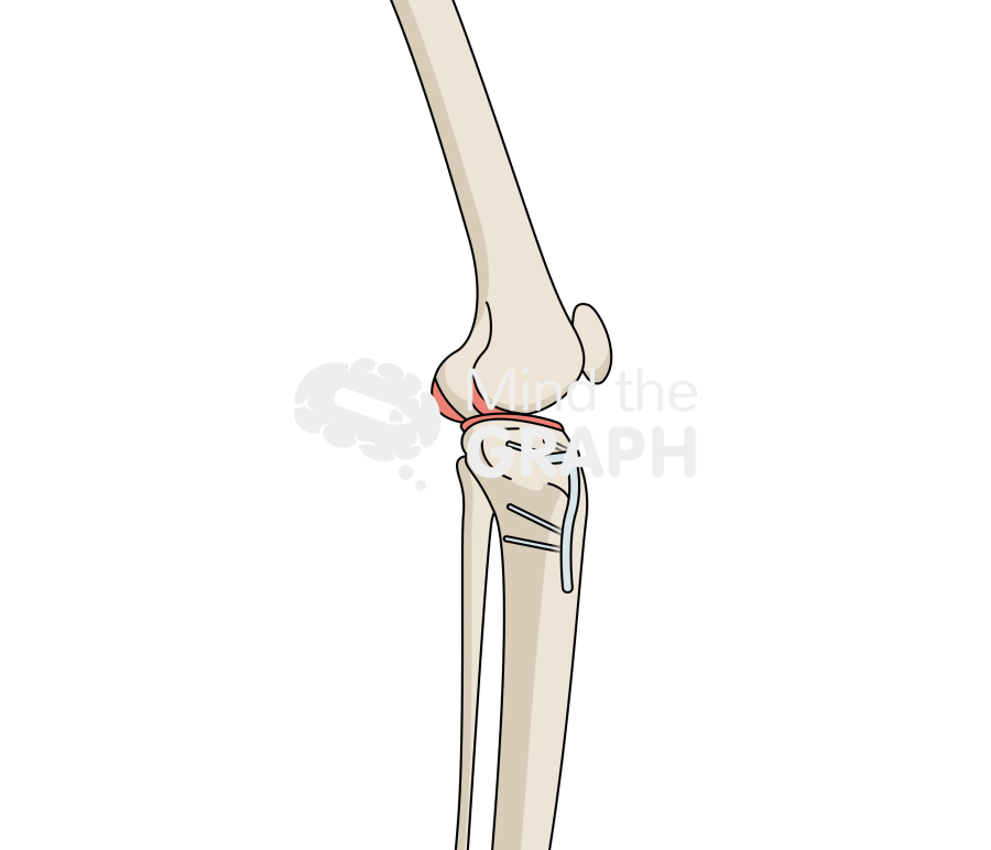 High tibial osteotomy anterior lateral full Icons, Symbols, Pictures, and Images