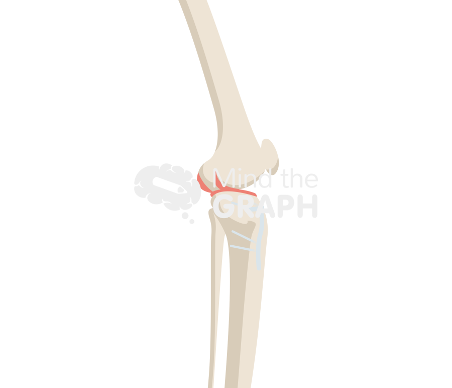 High tibial osteotomy anterior lateral full Icons, Symbols, Pictures, and Images