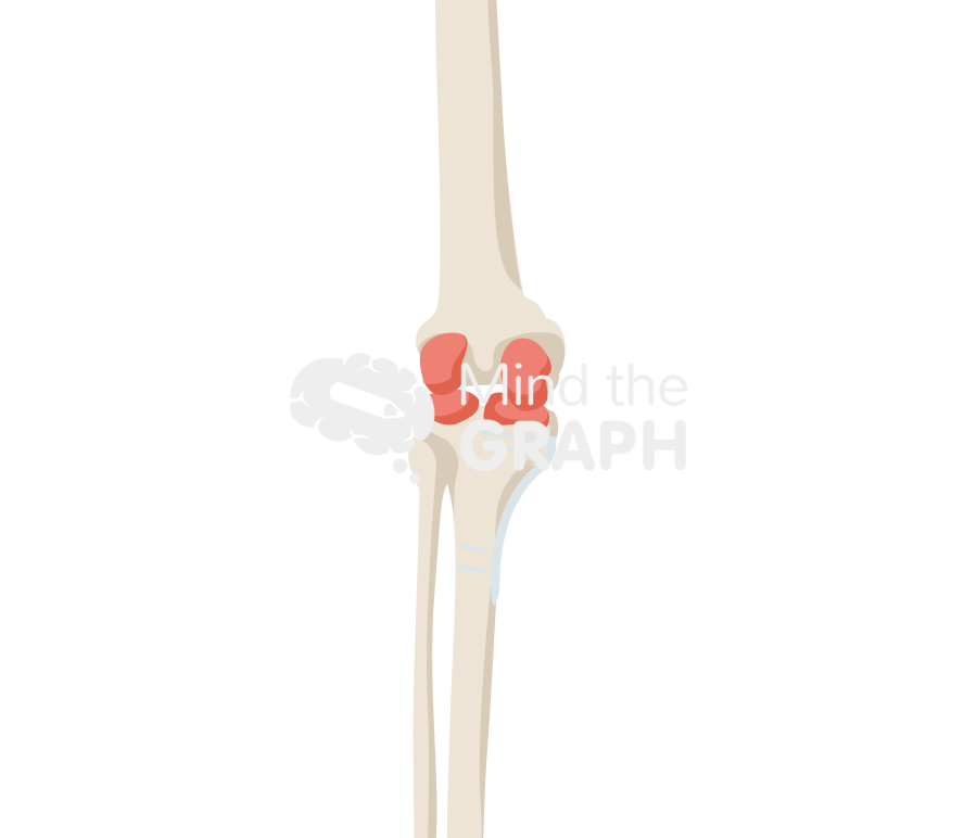 High tibial osteotomy anterior posterior bone full Icons, Symbols, Pictures, and Images