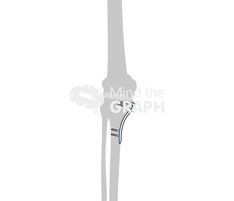 High tibial osteotomy bone Icons, Symbols, Pictures, and Images