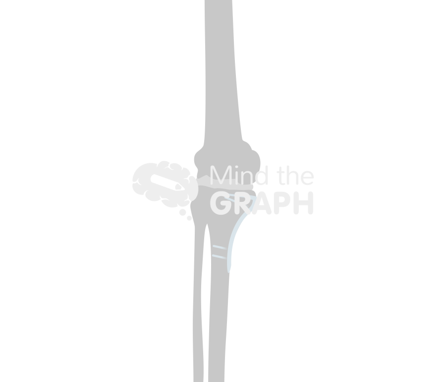 High tibial osteotomy bone Icons, Symbols, Pictures, and Images