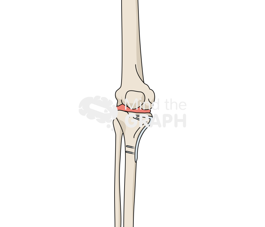 High tibial osteotomy bone full Icons, Symbols, Pictures, and Images