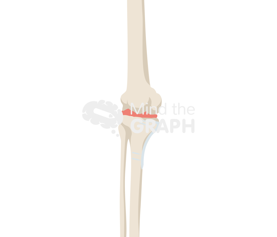 High tibial osteotomy bone full Icons, Symbols, Pictures, and Images