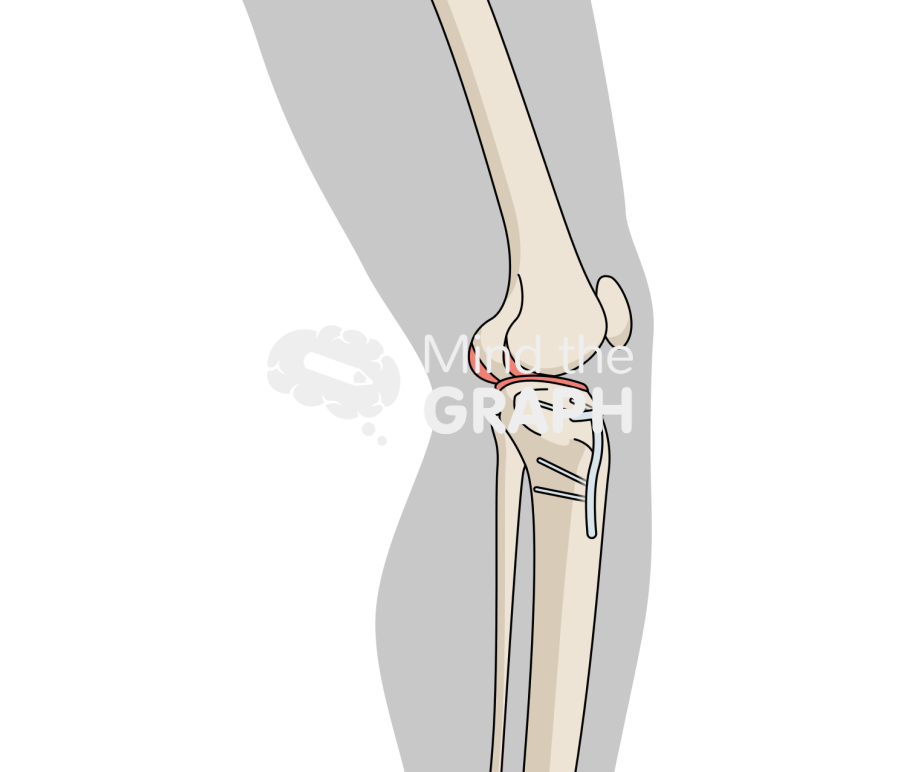 High tibial osteotomy lateral body Icons, Symbols, Pictures, and Images
