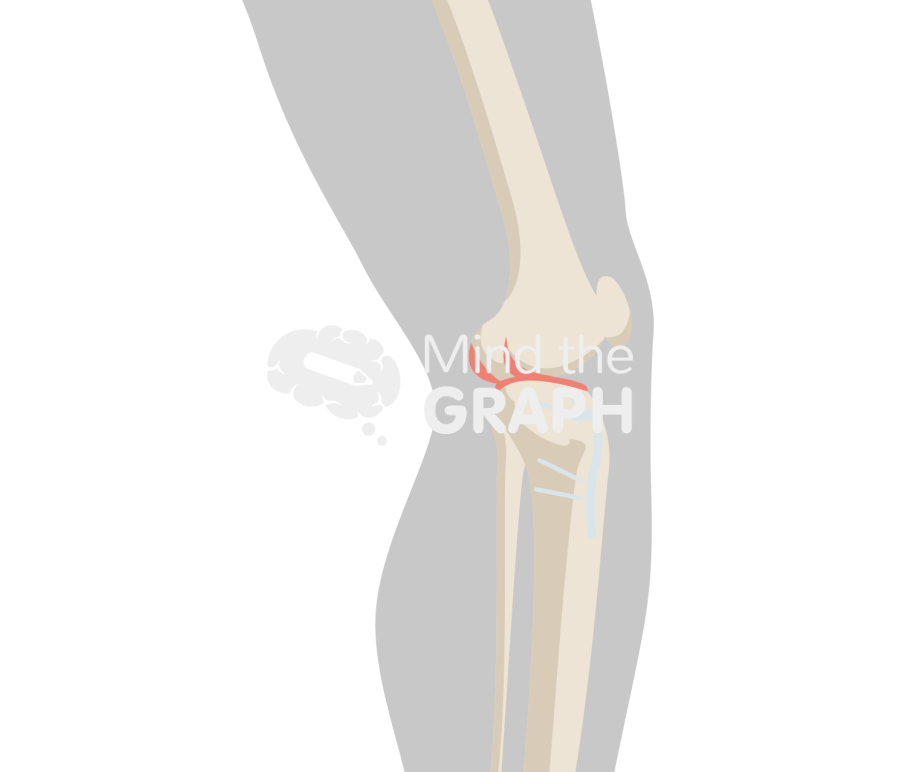 High tibial osteotomy lateral body Icons, Symbols, Pictures, and Images