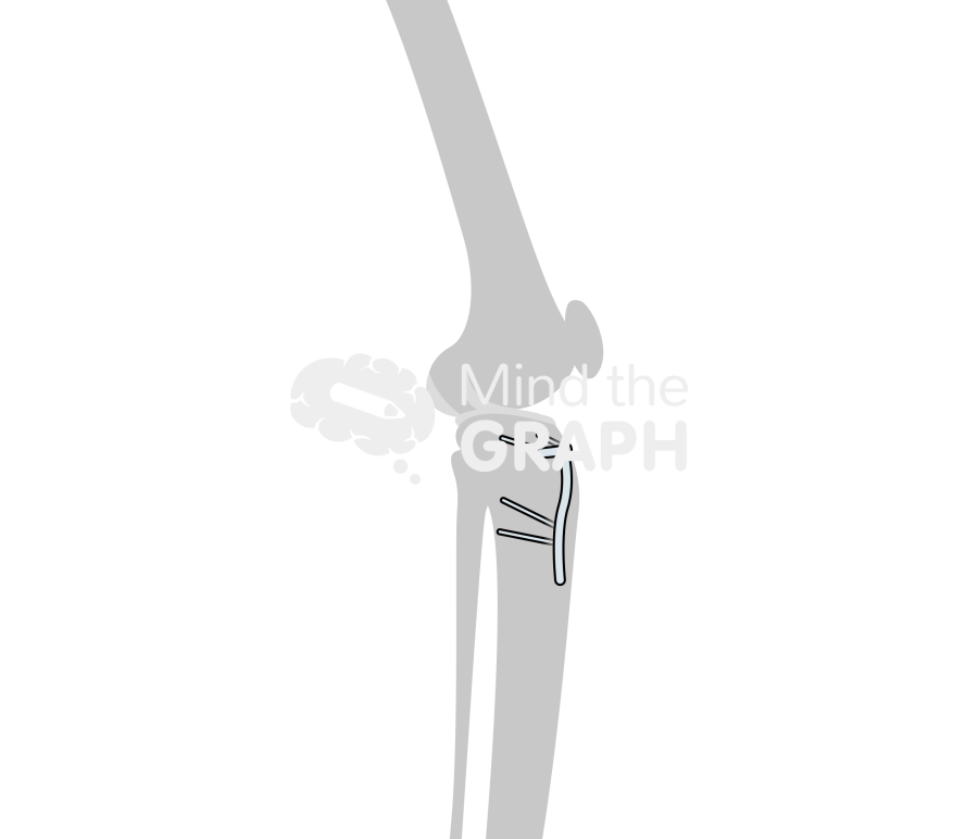 High tibial osteotomy lateral bone Icons, Symbols, Pictures, and Images