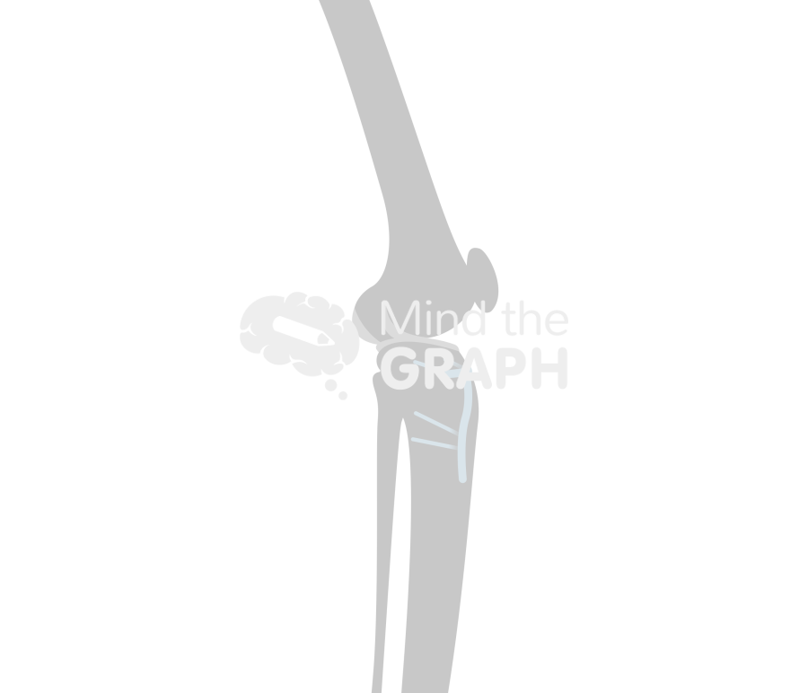 High tibial osteotomy lateral bone Icons, Symbols, Pictures, and Images