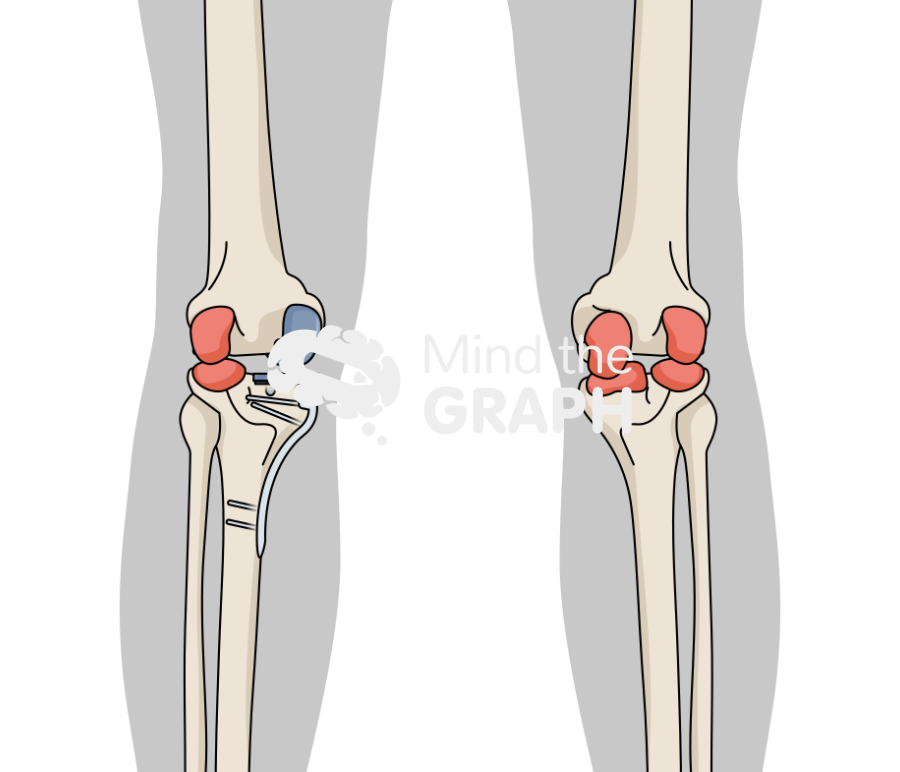 High tibial osteotomy unicompartmental knee arthroplasty anterior posterior body Icons, Symbols, Pictures, and Images