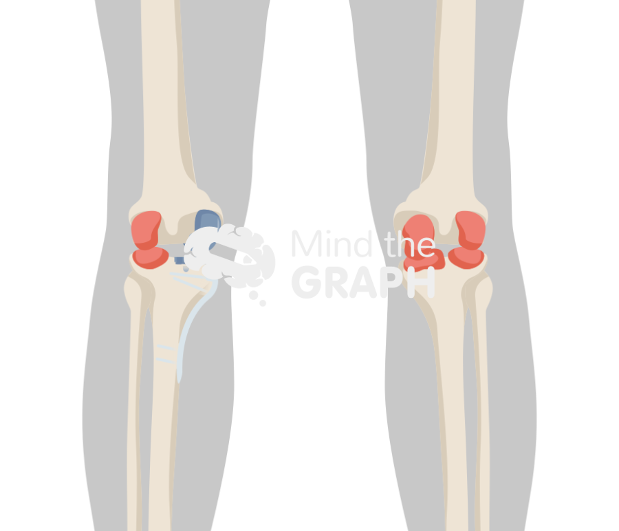 High tibial osteotomy unicompartmental knee arthroplasty anterior posterior body Icons, Symbols, Pictures, and Images