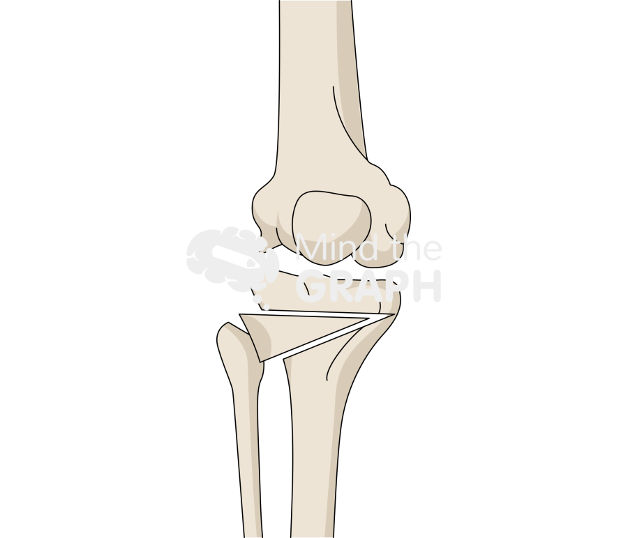 High tibial osteotomy with closing wedge Icons, Symbols, Pictures, and Images