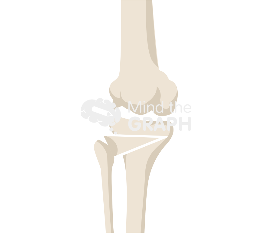 High tibial osteotomy with closing wedge Icons, Symbols, Pictures, and Images