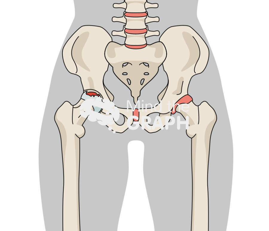 Hip avascular necrosis stage III body Icons, Symbols, Pictures, and Images