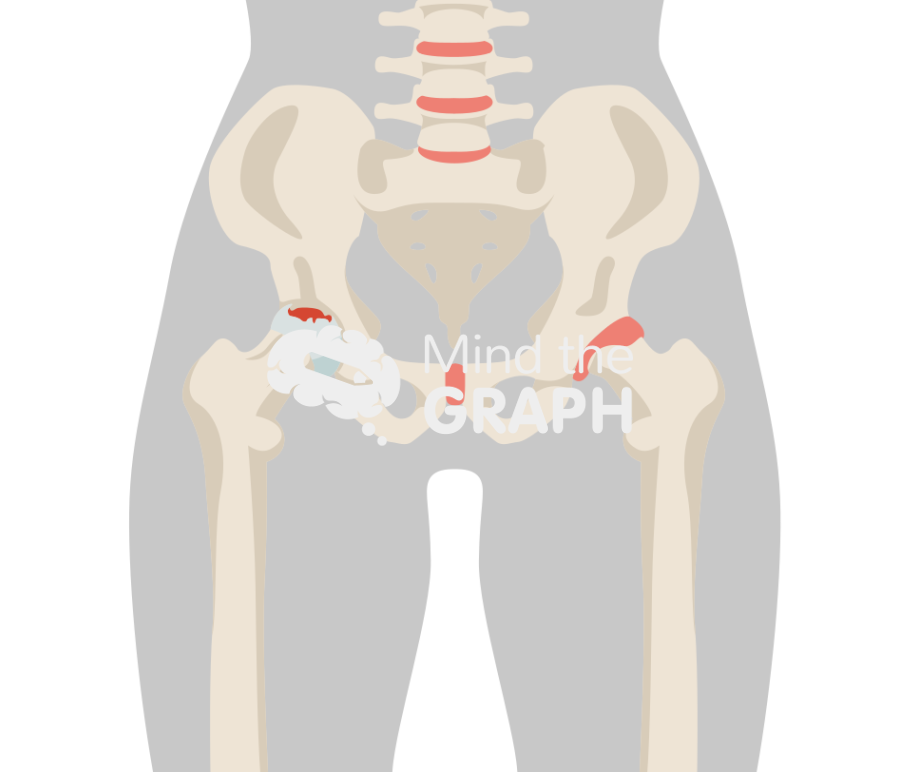 Hip avascular necrosis stage III body Icons, Symbols, Pictures, and Images