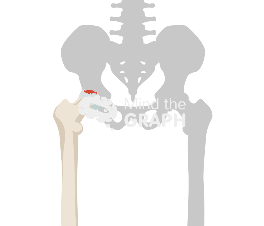 Hip avascular necrosis stage III bone Icons, Symbols, Pictures, and Images