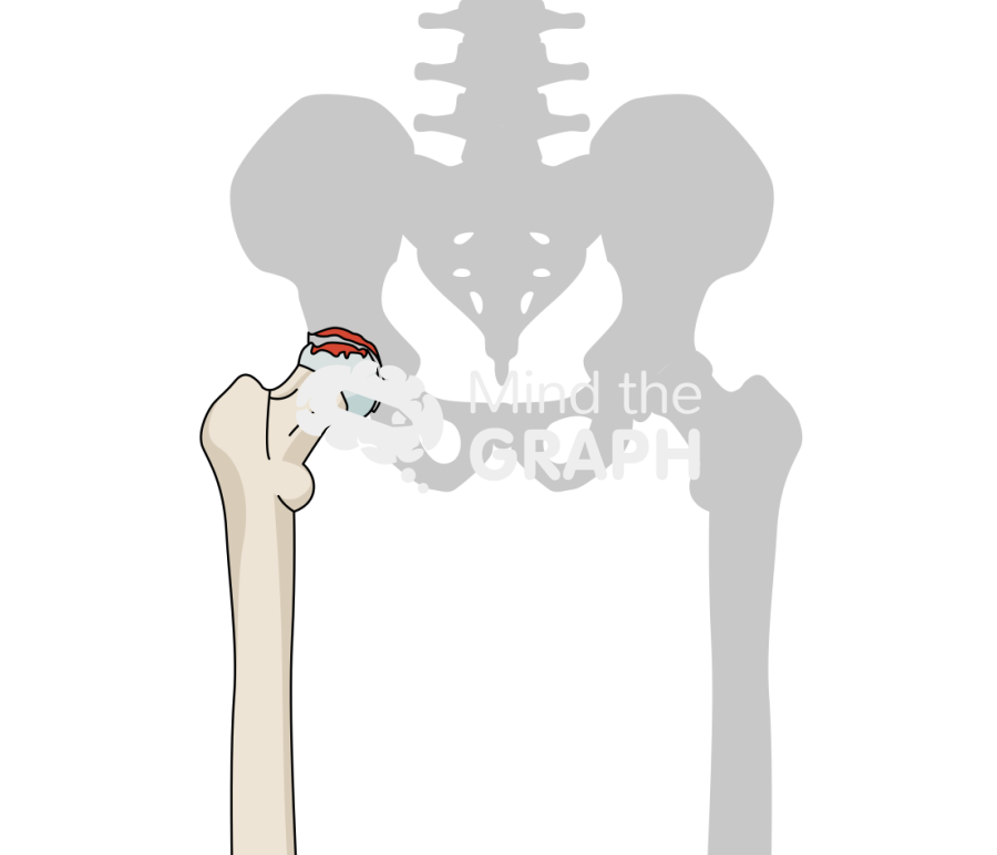 Hip avascular necrosis stage IV bone Icons, Symbols, Pictures, and Images