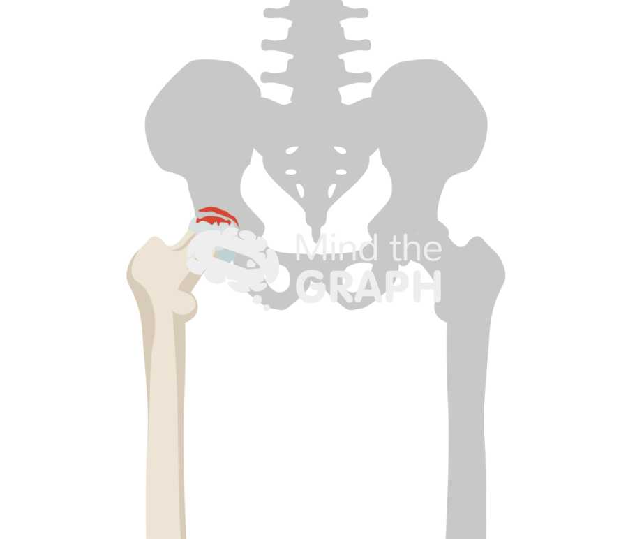 Hip avascular necrosis stage IV bone Icons, Symbols, Pictures, and Images