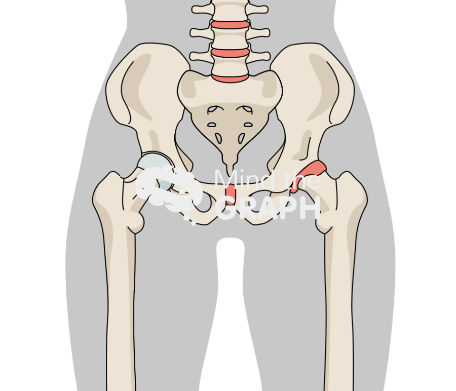 Hip avascular necrosis stage I body Icons, Symbols, Pictures, and Images