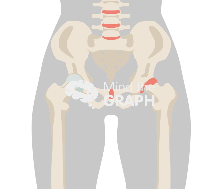 Hip avascular necrosis stage I body Icons, Symbols, Pictures, and Images