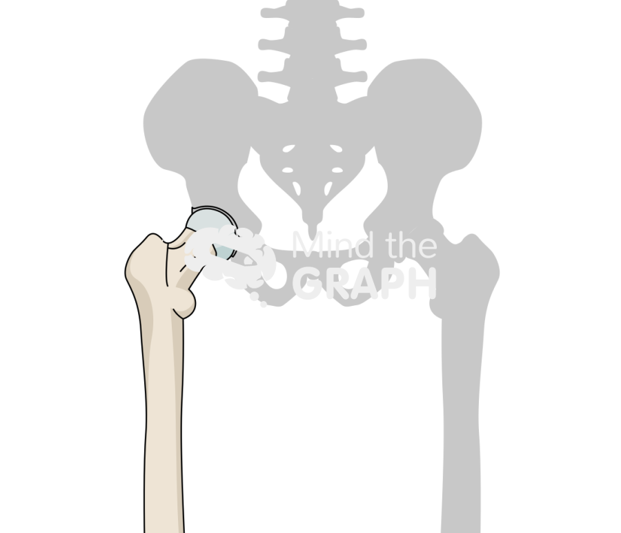 Hip avascular necrosis stage I bone Icons, Symbols, Pictures, and Images