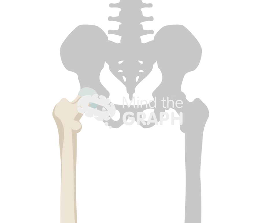 Hip avascular necrosis stage I bone Icons, Symbols, Pictures, and Images