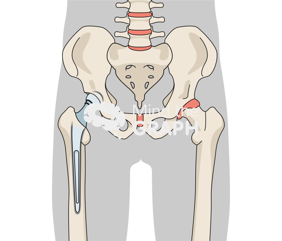 Hip cemented hemiarthroplasty body Icons, Symbols, Pictures, and Images