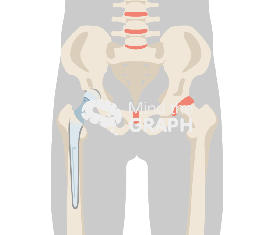 Hip cemented hemiarthroplasty body Icons, Symbols, Pictures, and Images